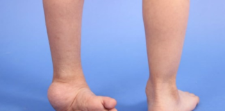 El Municipio de Pastaza, reafirmando su compromiso con la salud infantil, ha anunciado una iniciativa en coordinación con la Fundación Hermano Miguel y Miraclefeet para brindar apoyo y tratamiento a bebés y niños con pie equino.